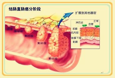 军医提醒勿将所有便血当痔疮出血