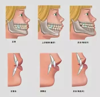 伤不起的“牙齿畸形会遗传”