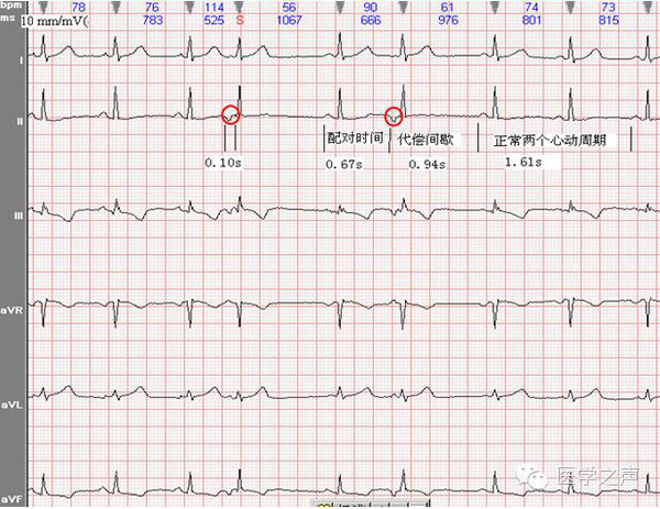 心电图课堂|第9期:交界性早搏_搜狐健康_搜狐网原标题