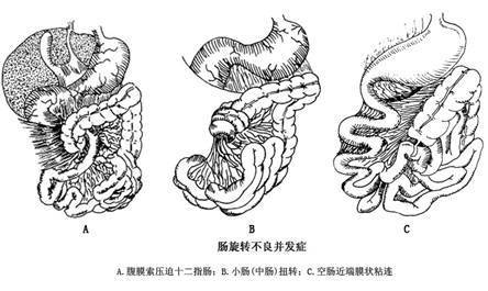 肠旋转不良时,由于肠管位置变异和肠系膜附着不全,易导致肠梗阻