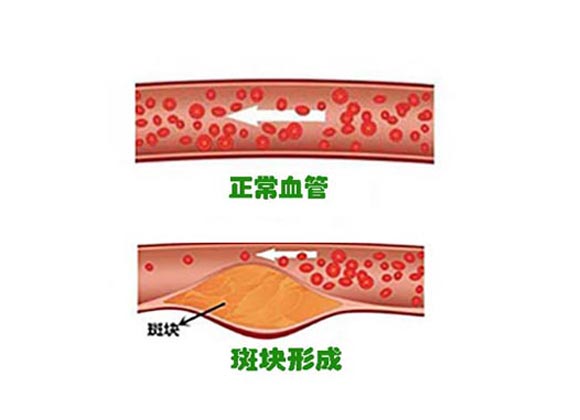血管在人类各种"造作"后就受伤了,堆积在血管壁的 脂质斑块越来越大