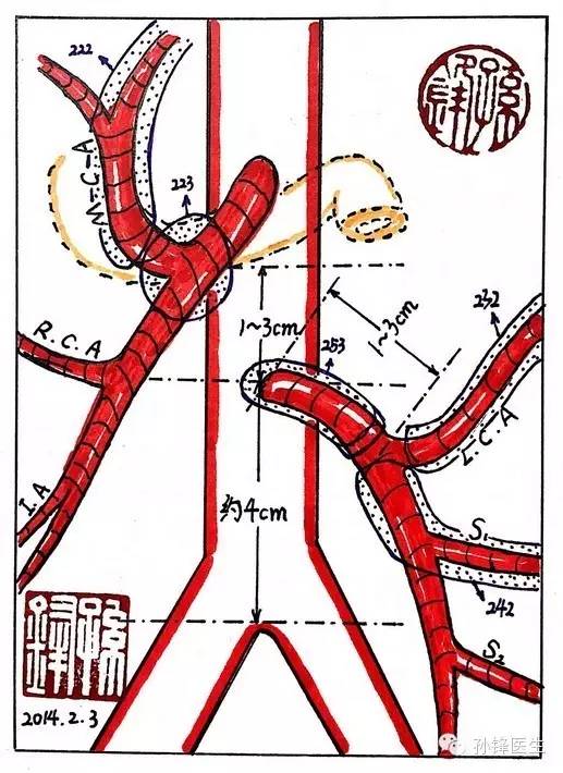 原创视频腹腔镜辅助乙状结肠癌根治性切除术1