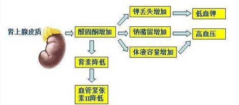 新闻速读丨原发性醛固酮增多症指南更新