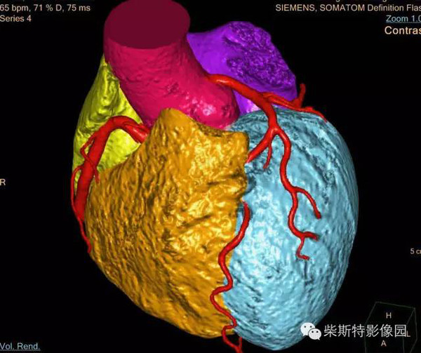 有了这些图解还怕看不穿冠状动脉心肌桥