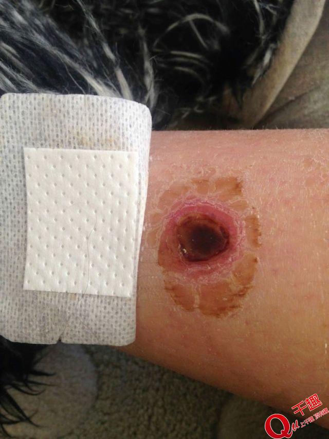 她说,"在我的腿上出现了一个洞."皮肤科医生不得不切掉坏死的组织.