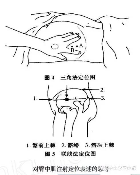 3)日本臀中肌注射定位法:取髂前上棘和髂后上棘的联线的外侧1/3处为