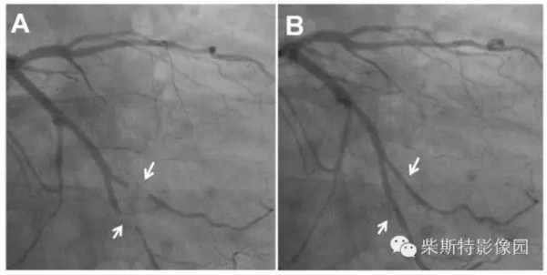 ("挤牛奶现象")冠脉造影静态图像欣赏完了心肌桥的冠脉cta影像学表现