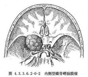 蝶骨嵴内13脑膜瘤切除术流程