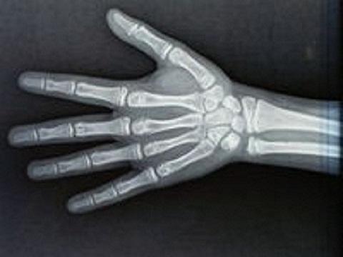 拍摄对象:弱势手(左或右)的掌,指,腕骨全部,及桡尺骨远侧端骨干3-4