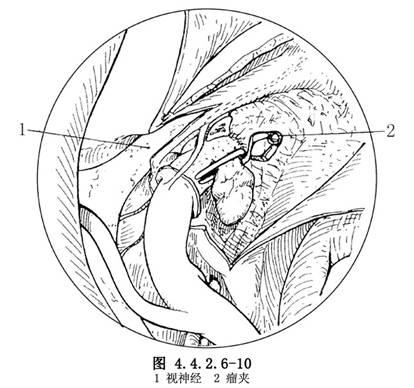 颈内动脉床突段有交感神经的颈动脉丛,损伤后可引起缩瞳,应尽量少做