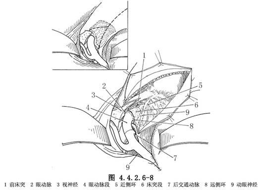 颅内床突段动脉瘤夹闭术