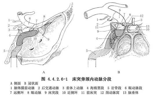 颅内床突段动脉瘤夹闭术