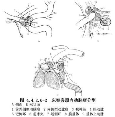 颅内床突段动脉瘤夹闭术