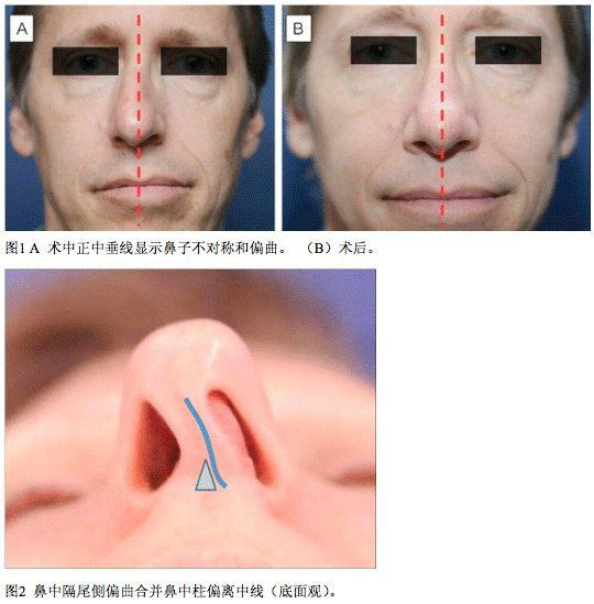 对鼻中隔偏曲患者实施健康教育的体会