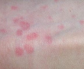 湿疹是一回事吗?怎么治疗最有效?