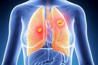 小细胞肺癌有哪些症状?该如何预防好