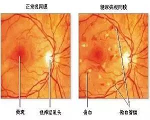 干货丨糖尿病视网膜病变危险因素排行榜