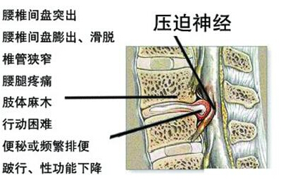 科普腰椎间盘突出的症状及最佳治疗方案-搜狐