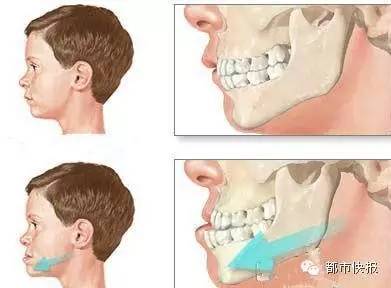 彭友俭检查发现,湘湘是典型的"地包天,拍片显示她只剩下一对牙能够