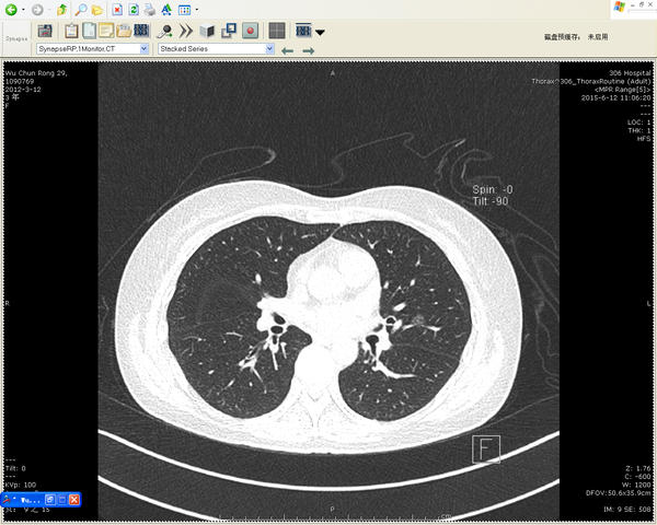 胸部低剂量螺旋CT-肺癌高危人群的首选