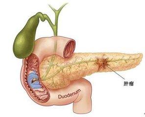 "新癌王—胰腺癌及其早期诊断