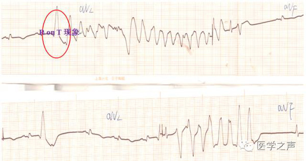 心电图课堂|第18期:尖端扭转型室速