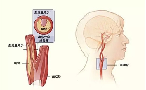 使管腔狭窄甚至闭塞,导致局灶性急性脑供血