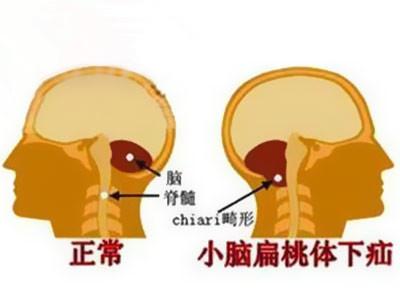 小脑扁桃体下疝是一种后脑先天性疾病.