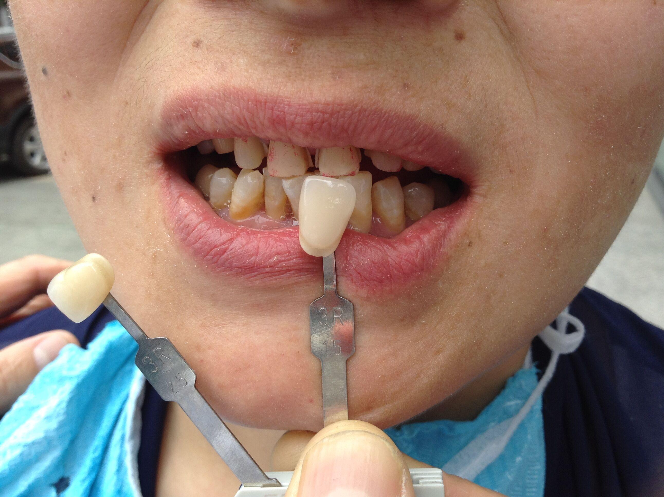 美丽牙医/MEDENTAL 光固化M177前后牙通用纳米瓷化树脂 A1，4g装