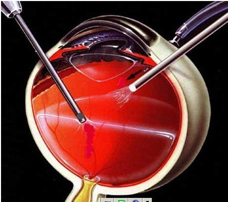 玻璃体切除手术后,多久才能恢复视力?