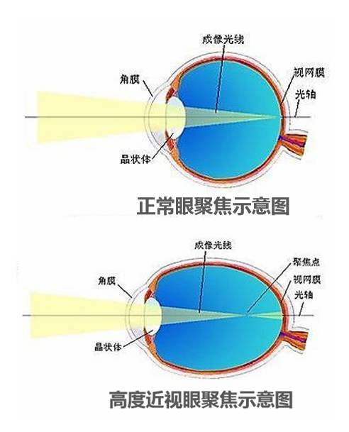这两张图,分别代表的是正常眼以及高度近视眼的眼部形态.
