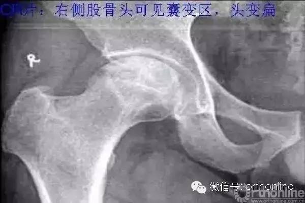 X光片解读股骨头坏死各类分期方法