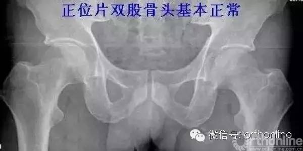X光片解读股骨头坏死各类分期方法