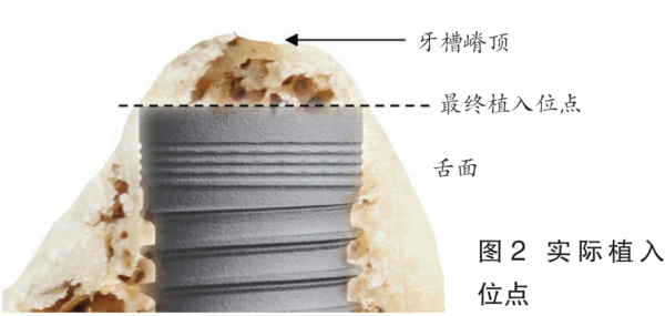 口腔种植手术学图解植入位点的处理