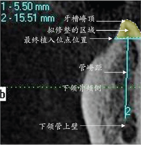 下颌骨横断面cbct影像图(实际植入位点与管嵴距)