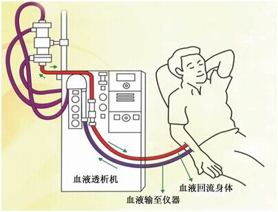 血液透析通过什么原理排水_血液透析原理示意图