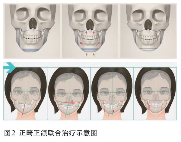 健康 正文  目前,正畸正颌联合治疗是矫正颌骨畸形的最佳方法.