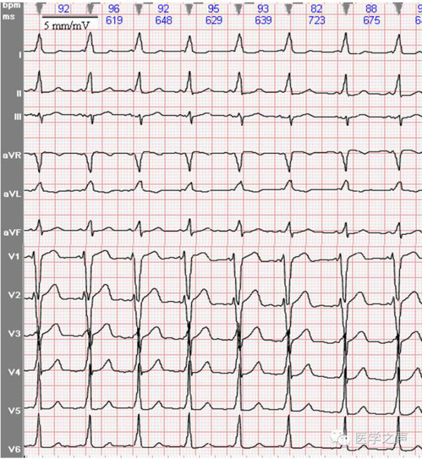 心电图课堂|第23期:预激综合征