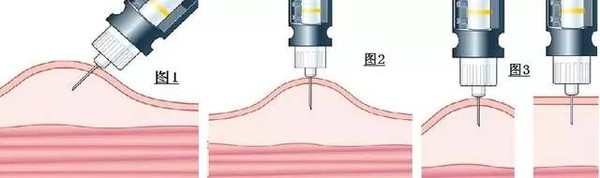 胰岛素及其类似物的使用问题|胰岛素的前世今生