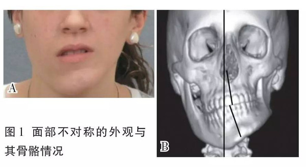其中,造成严重面部不对称的原因主要是颌骨发育不对称.