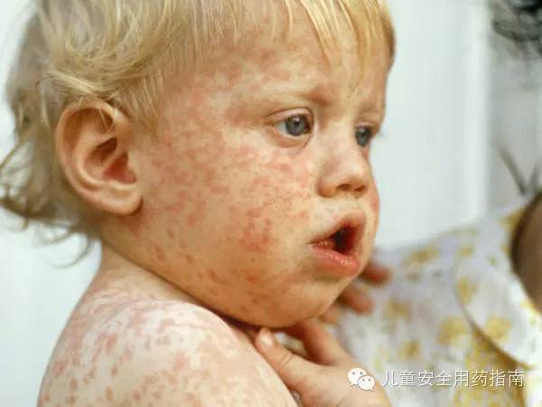 幼儿急疹家长最关心的问题,别和风疹、麻疹搞