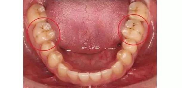 成人牙齿出现黑点且不痛,一般有两种可能. 一种是 色素沉着.