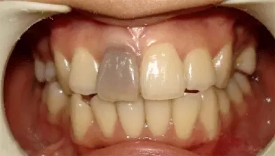死髓牙四,年龄老化也会造成牙齿变黑牙齿珐琅质随年龄增长而变薄,渐渐