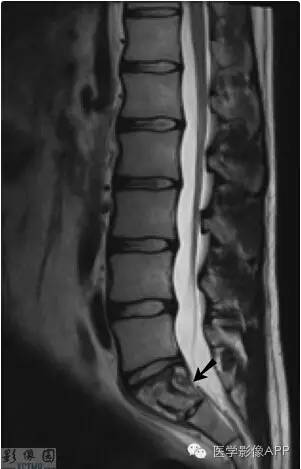 有康医学影像app推荐:骶1椎体病变mri病例