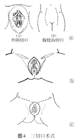 《2016nccn外阴鳞癌临床实践指南(第一版)》解读