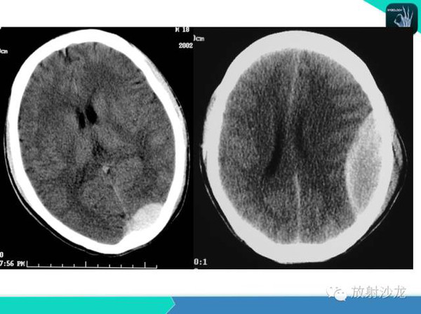 不用找啦!最全的颅脑常见病ct表现在这里!