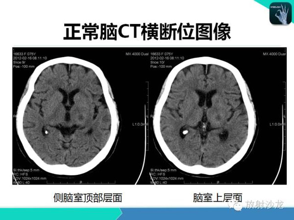 颅内血管性病变:脑出血(急性脑出血,脑出血破入侧脑室);脑梗塞(腔隙