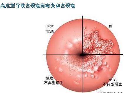 hpv人口_hpv症状图片