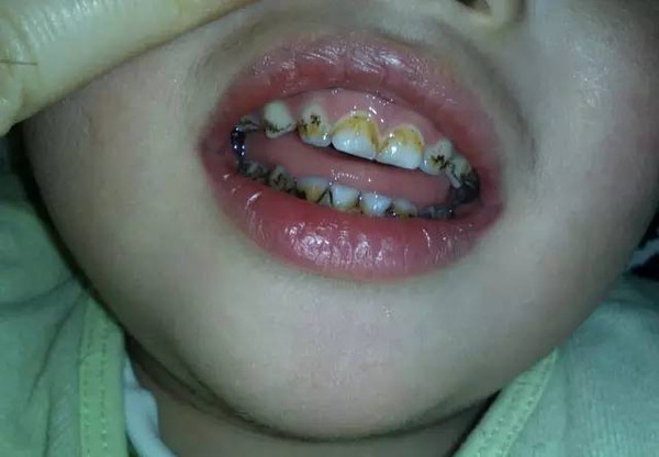 1岁的武汉宝宝萌萌12颗牙齿全部黑掉了,看上去就像40岁的"老烟枪",就