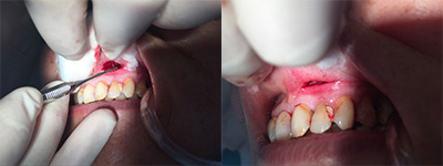 慢性根尖周炎,慢慢形成瘘管,最后发展为根尖囊肿 治疗方案:对b3牙进行